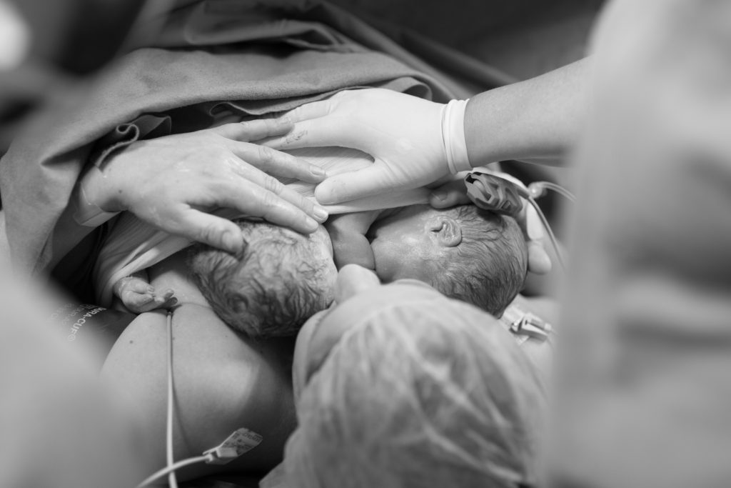 Zwillingsschwangerschaft: Ein Kaiserschnitt in Bildern. 